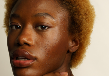 Skin & Out - Solution globale et naturelle pour l'acné