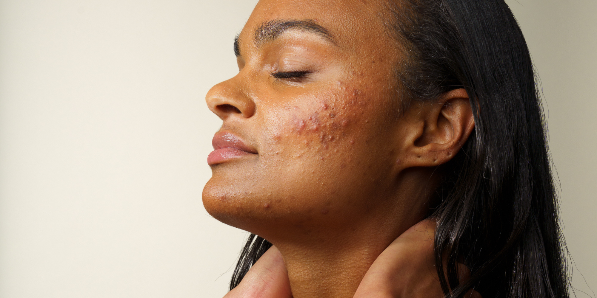 Le stérilet en cuivre et l'acné : quel lien ? - Skin & Out