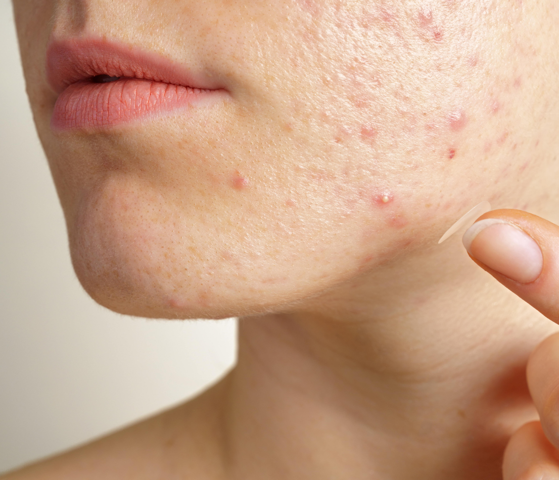 L'acné du menton - Skin & Out
