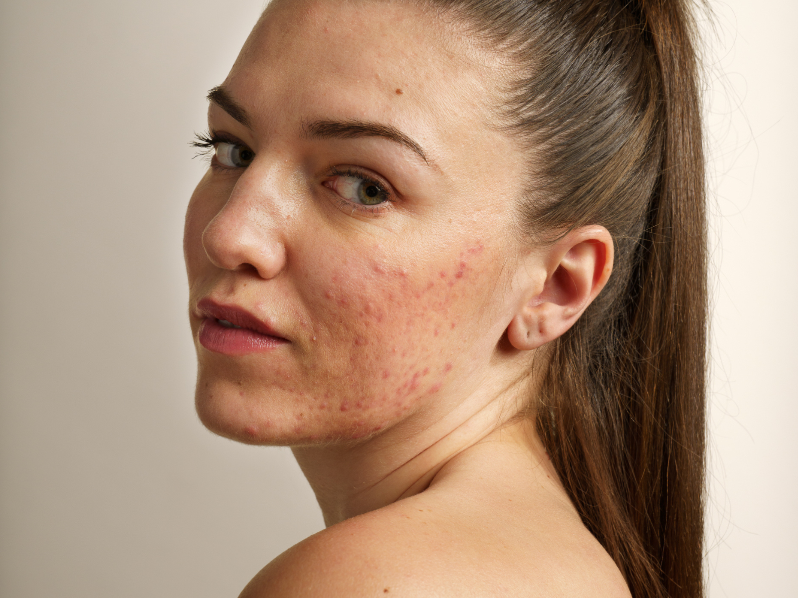 L'acné sévère - Skin & Out