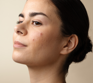 Arrêt de pilule acné de l'adulte - Skin & Out experts de l'acné