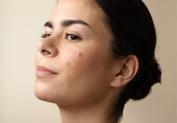 Arrêt de pilule acné de l'adulte - Skin & Out experts de l'acné