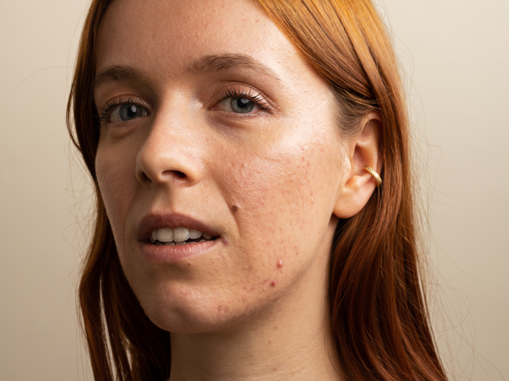 Les causes de l'acné inflammatoire